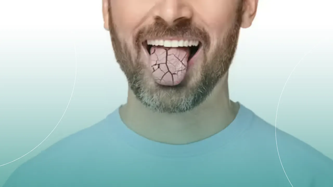 علل خشکی دهان چیست و چطور آن را برای همیشه درمان کنیم؟