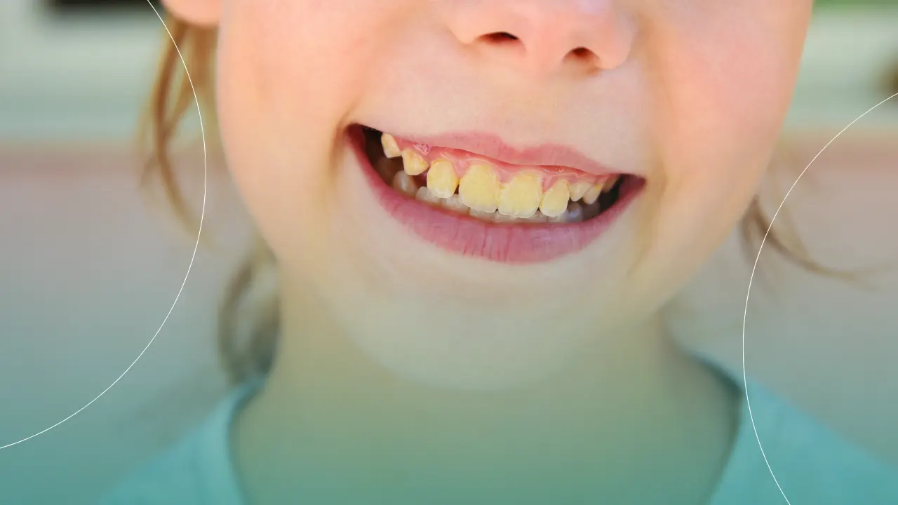 آشنایی با مهم ترین علل زرد شدن دندان ها + روش های رفع آن