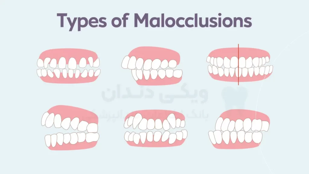انواع مشکلات ارتودنسی