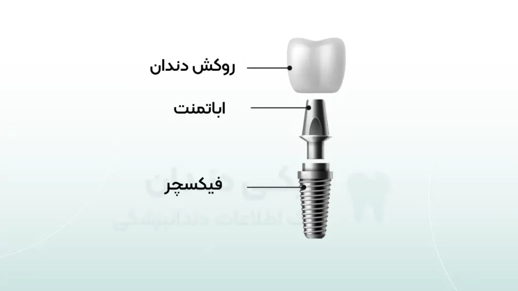 اینفوگرافی اجزای ایمپلنت دندان