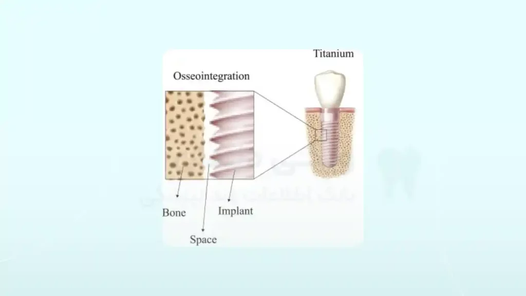 جوش خوردن ایمپلنت دندان
