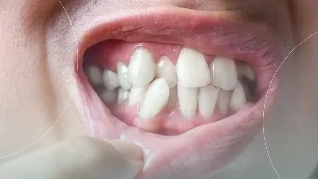 شلوغی بیش از حد دندان ها