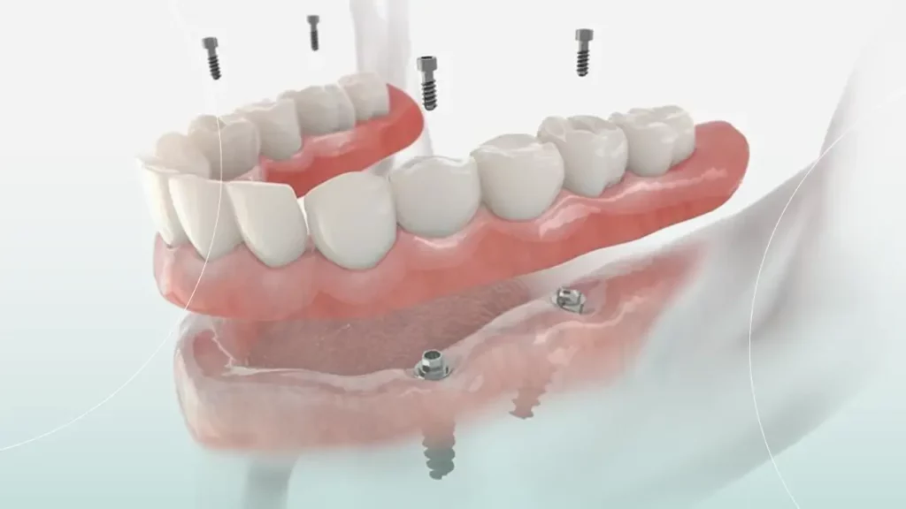 عکس ایمپلنت دندان all-on-4