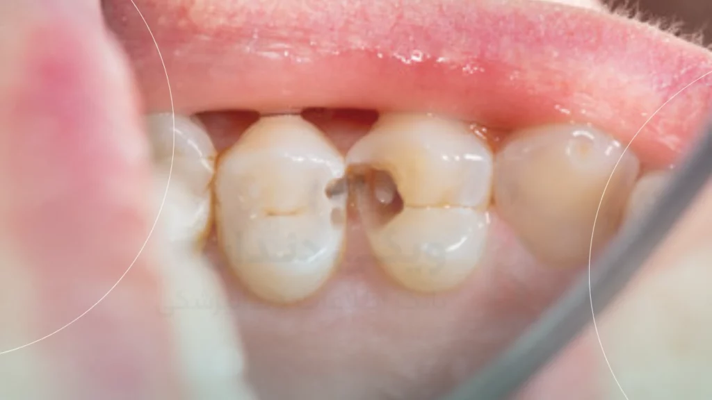 هزینه پر کردن دندان بر اساس گستردگی آسیب