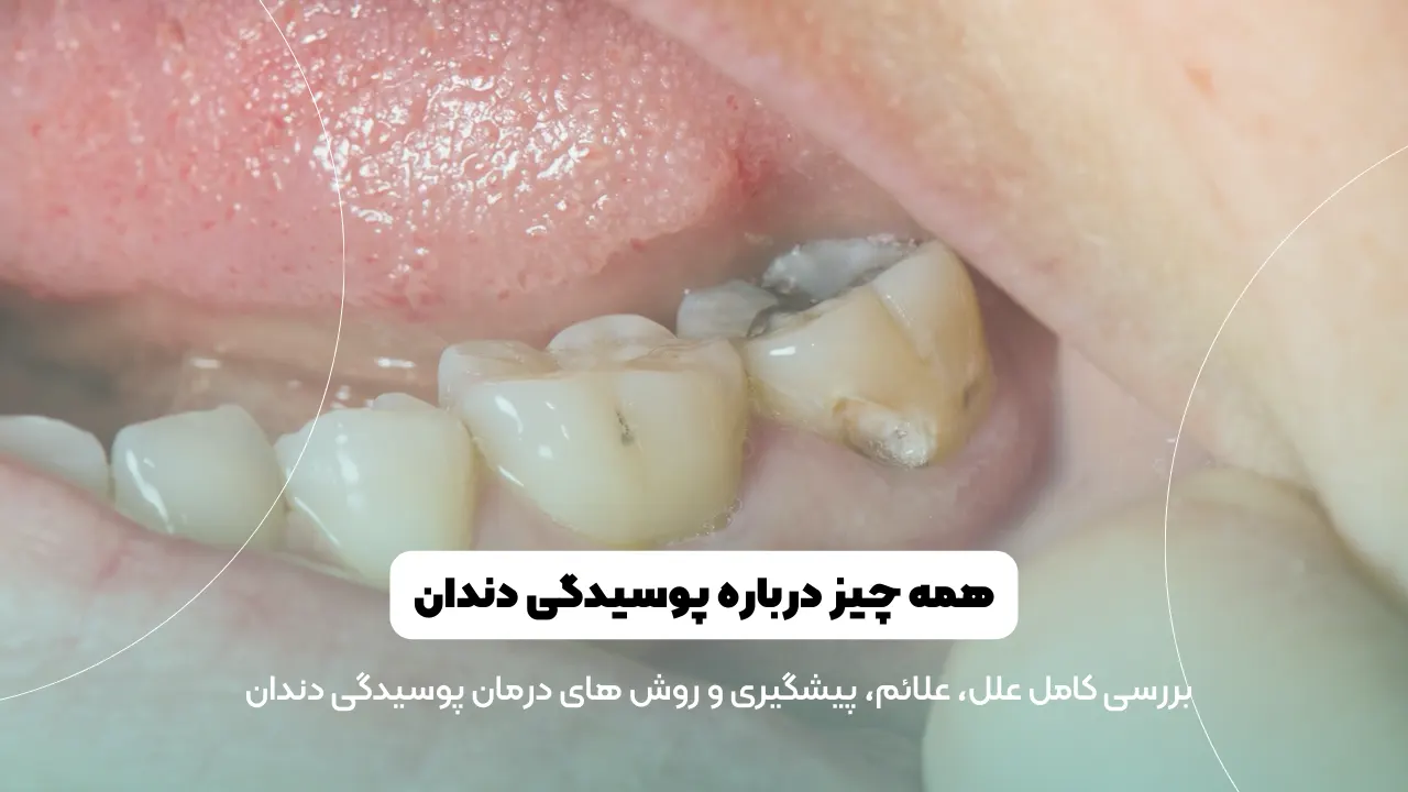 عکس پوسیدگی دندان