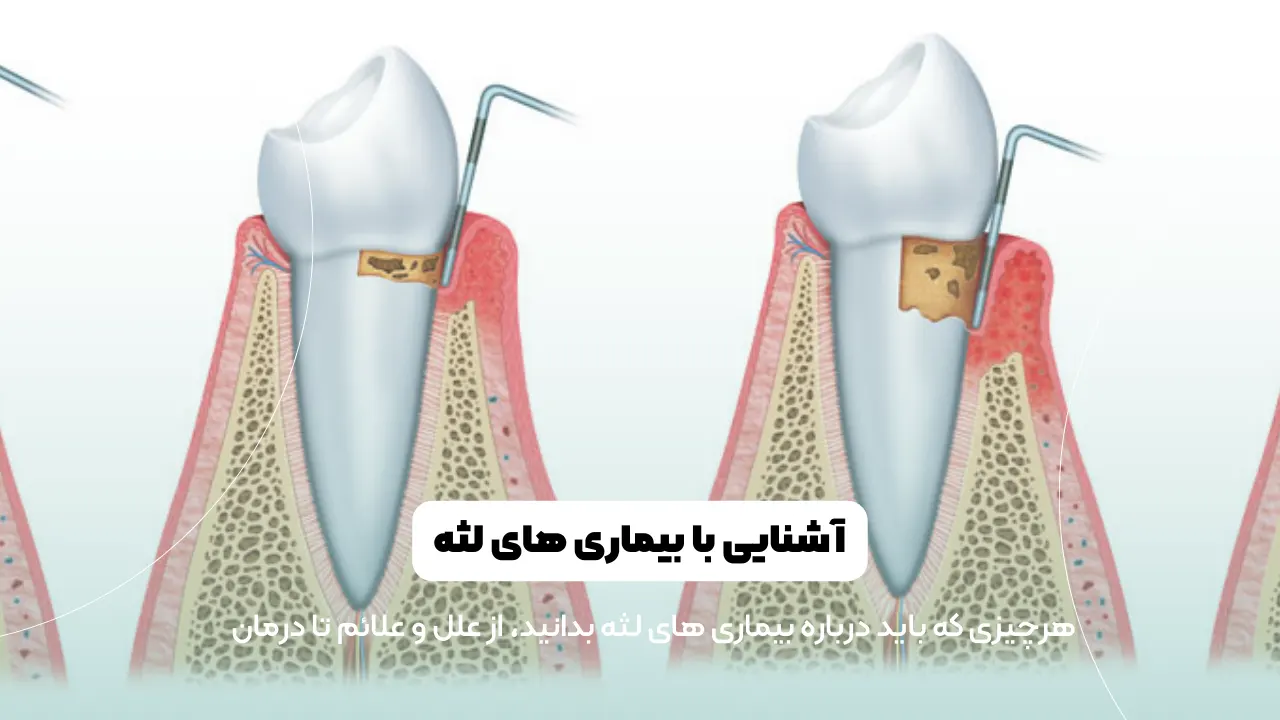 بیماری های لثه