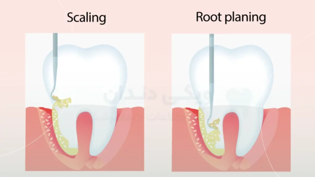 عکس شماتیک تفاوت جرمگیری دندان و درمان روت پلنینگ