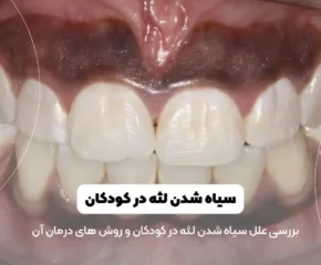 سیاهی لثه در کودکان شاخص