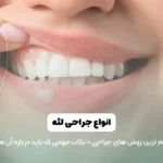 عمل جراحی لثه