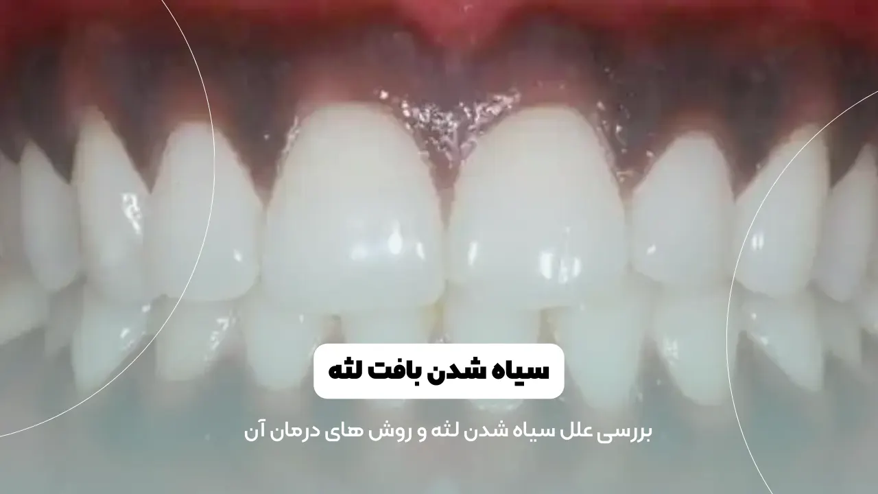 عکس سیاه شدن لثه ها