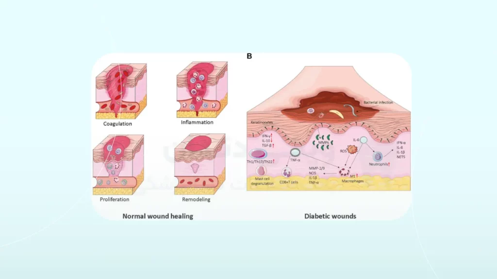 بهبود زخم در افراد دیابتی