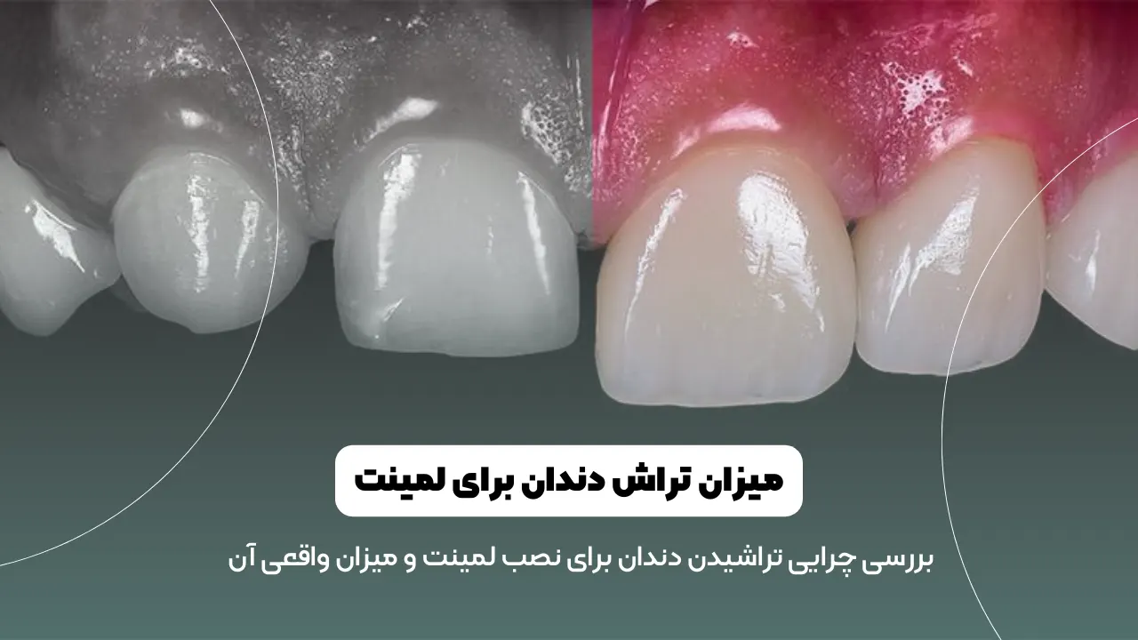 میزان تراش دندان برای لمینت شاخص