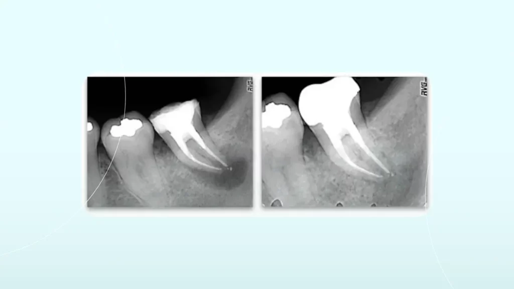 عکس دندان عصب کشی شده بعد از درمان ریشه
