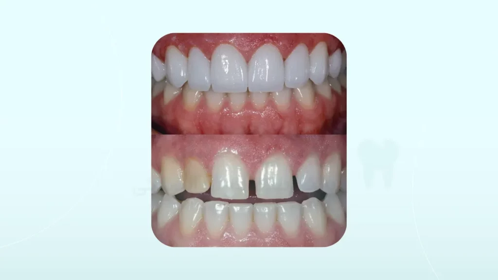 عکس لمینت دندان Feldspathic Porcelain Veneers