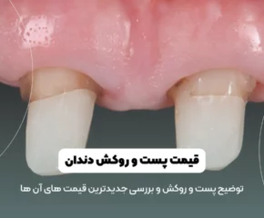 قیمت پست و روکش دندان شاخص