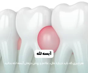 آبسه لثه شاخص