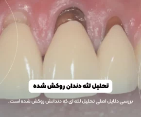 تحلیل لثه دندان روکش شده شاخص