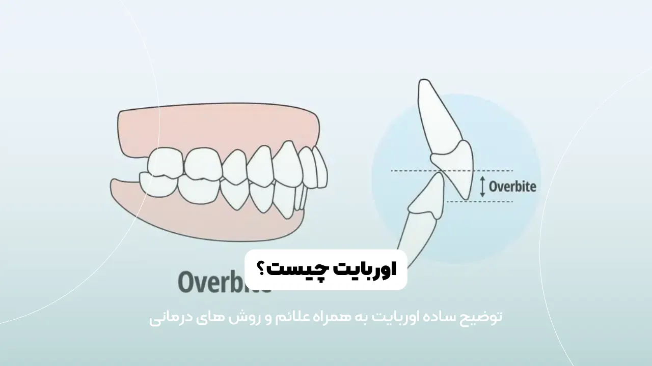 عکس اوربایت شاخص